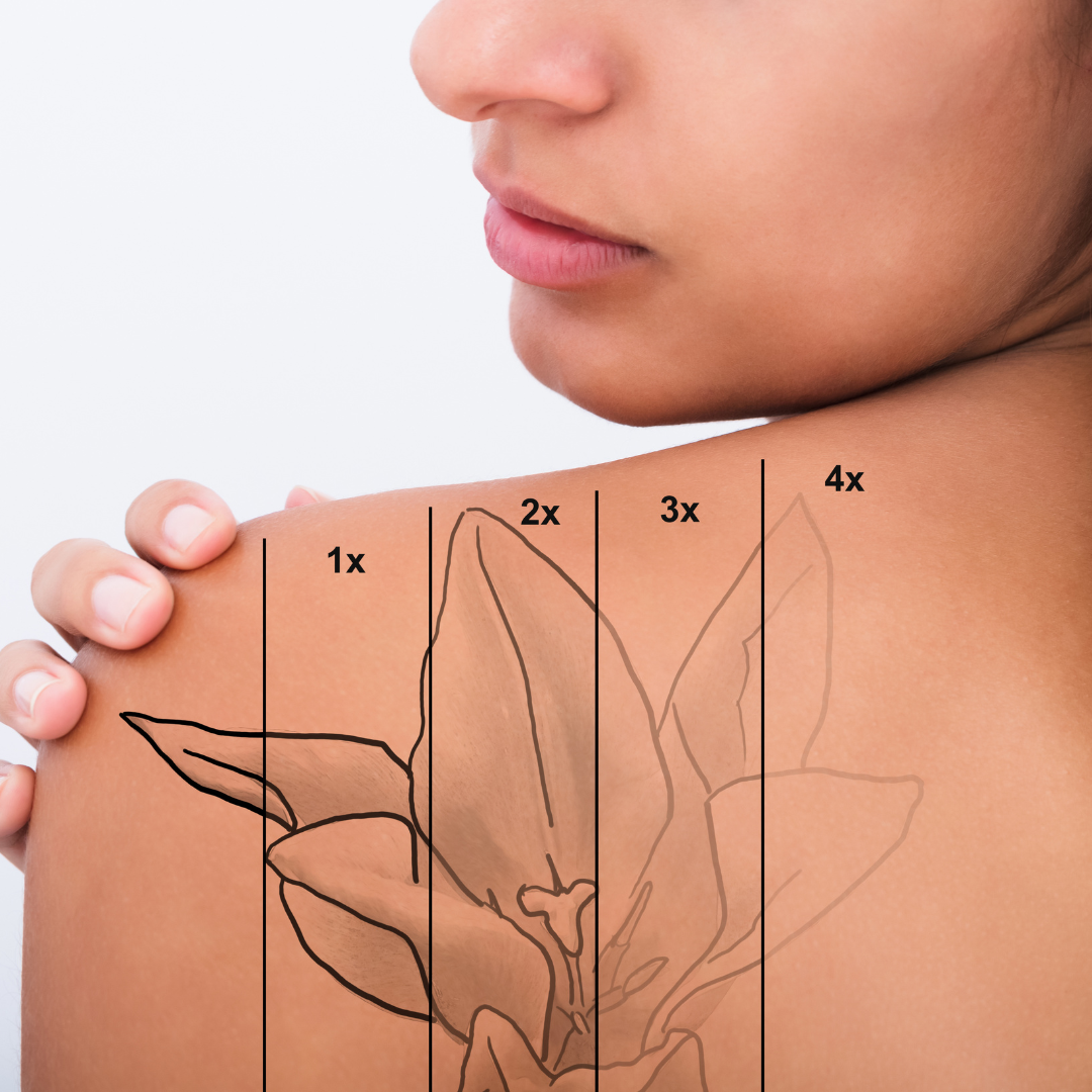 Laser Tattoo Removal